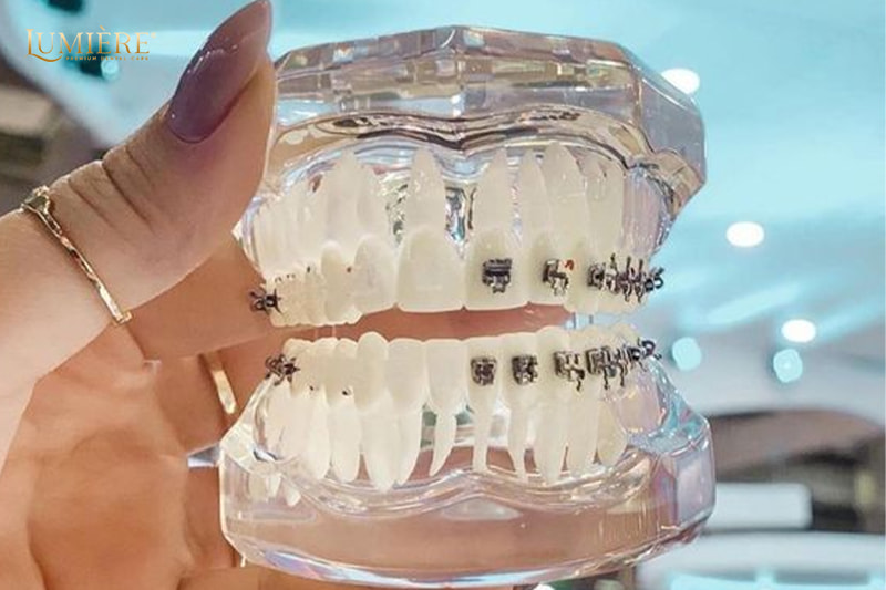 Mắc cài chỉnh nha - Nụ cười rạng rỡ chỉ sau 3 tháng! 3 Mắc cài chỉnh nha có hiệu quả sau bao lâu?