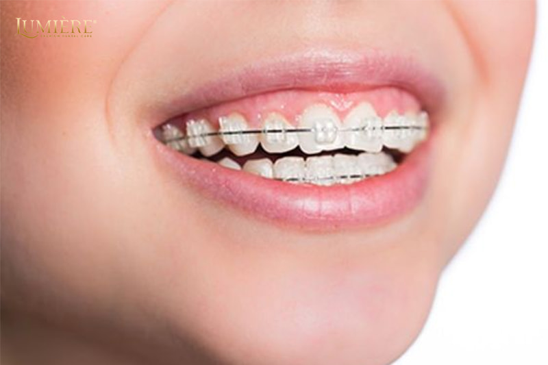 Mắc cài chỉnh nha - Nụ cười rạng rỡ chỉ sau 3 tháng! 1 Mắc cài chỉnh nha là gì?
