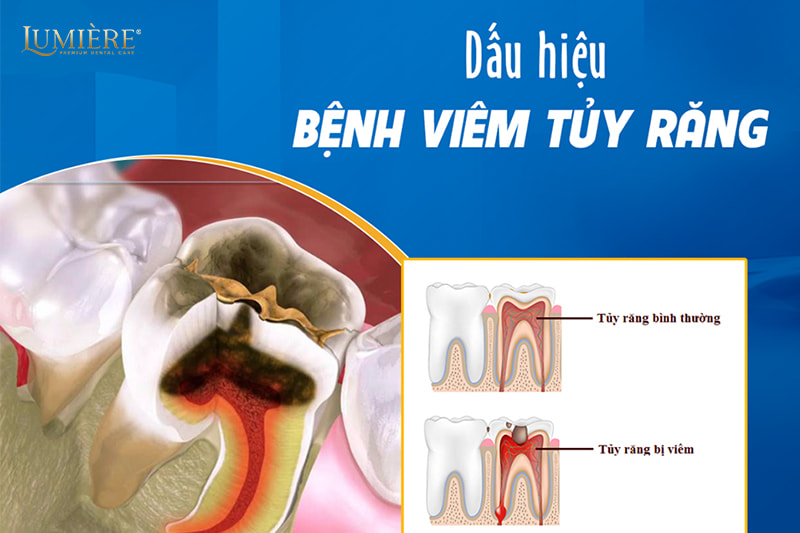 Nhận biết sớm viêm tủy răng qua 7 triệu chứng điển hình 2 Dấu hiệu bệnh viêm tủy răng
