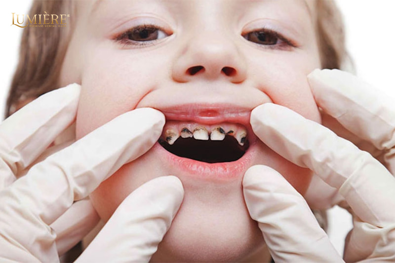 Trẻ bị viêm tủy răng sữa: Dấu hiệu, nguyên nhân và cách điều trị 3 Cách điều trị viêm tủy răng sữa cho trẻ