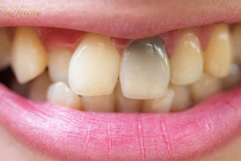 Tủy răng bị hoại tử: Nguyên nhân, dấu hiệu và cách điều trị 3 Cách điều trị tủy răng bị hoại tử hiệu quả