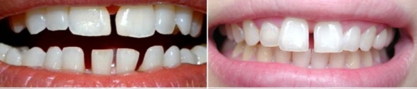 Răng thưa nguyên nhân do đâu và cách khắc phục hiệu quả 1 khac phuc rang thua tai nha