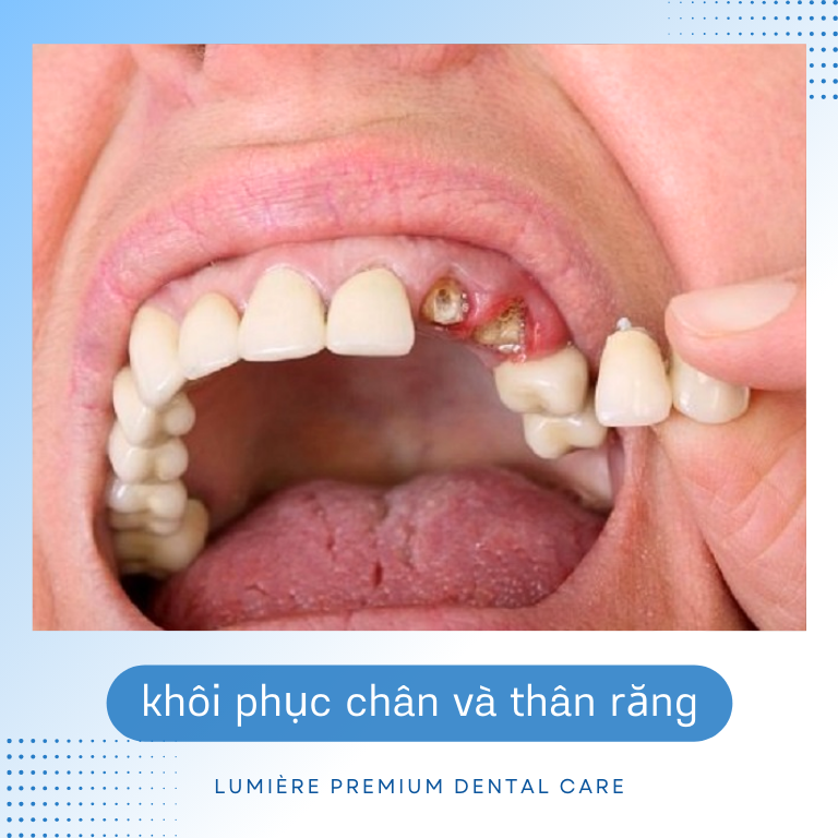 🦷 PHỤC HỒI RĂNG MẤT TỐI ƯU VỚI CẤY GHÉP IMPLANT – GIẢI PHÁP TOÀN DIỆN CHO NỤ CƯỜI HOÀN HẢO ✨ 2 2