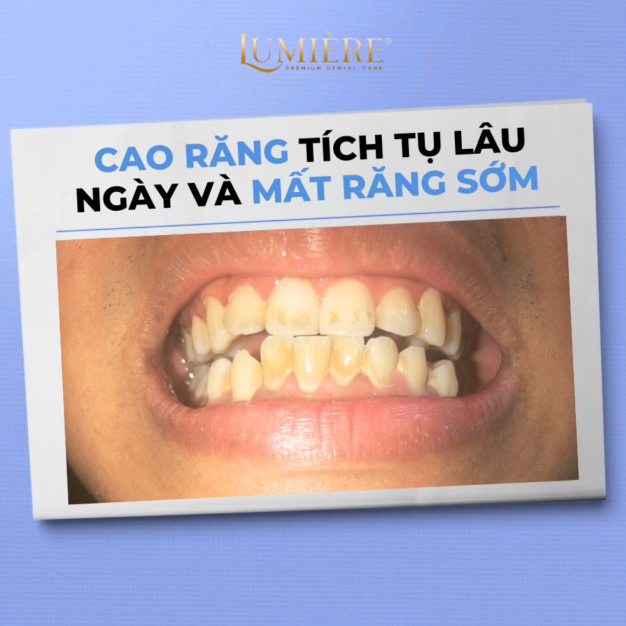 Ban tin ⚠️ DUNG XEM NHE VIEC KHONG KHAM RANG DINH KY 🦷