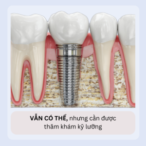 MAT RANG LAU NAM CON TRONG IMPLANT DUOC KHONG 1