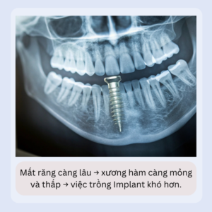 MAT RANG LAU NAM CON TRONG IMPLANT DUOC KHONG 2