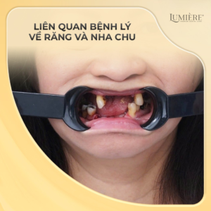 💥3 TRƯỜNG HỢP NÊN GHÉP XƯƠNG TRƯỚC KHI TRỒNG IMPLANT BẠN CẦN BIẾT!🦷 3 03 truong hop can ghep xuong truoc khi trong Implant 2