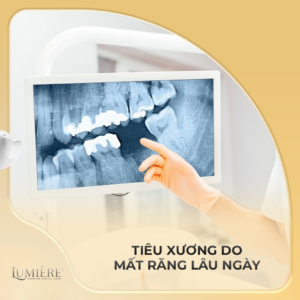 💥3 TRƯỜNG HỢP NÊN GHÉP XƯƠNG TRƯỚC KHI TRỒNG IMPLANT BẠN CẦN BIẾT!🦷 2 03 truong hop can ghep xuong truoc khi trong Implant 4