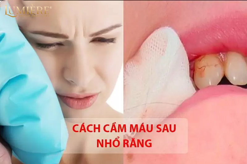 Một số mẹo cầm máu sau khi nhổ răng dễ làm, chóng lành vết thương 2 mẹo cầm máu sau khi nhổ răng